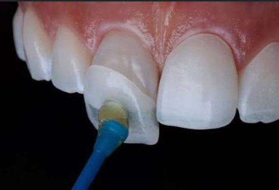 Veneer (Zirconia)